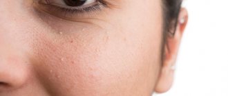 5 best ways to get rid of milia on face