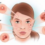 акне вульгарис