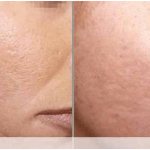 Antibiotics for acne