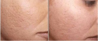 Antibiotics for acne