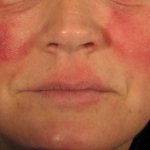 Anti-rosacea cream