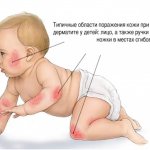 Атопический дерматит у младенца