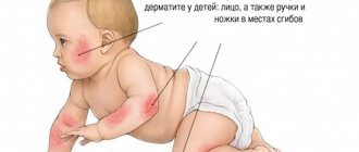 Атопический дерматит у младенца
