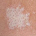 pityriasis alba in humans
