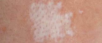 pityriasis alba in humans