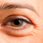 non-surgical blepharoplasty