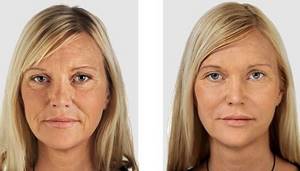 Биоармирование лица гиалуроновой кислотой: что это такое, отзывы, фото до и после