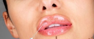 ботокс губ цена