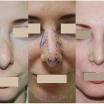 Была необходимость вторичной ринопластики