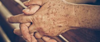 c glav - Черные пятна на руках