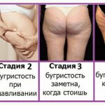 Cellulite definition, stages of cellulite development