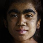 Чрезмерный волосяной покров