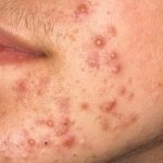 Demodicosis in humans