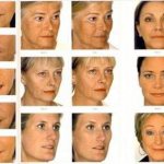 Dysport or Botox, which is better?