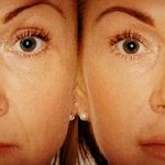 До и после процедуры