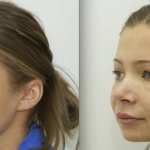 Эндоскопическая подтяжка средней зоны лица на фото после и до проведения
