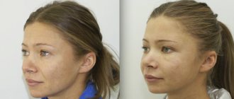 Endoscopic midface lift in the photo after and before