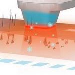 Эпиляция диодным лазером