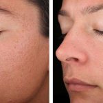 Erbium laser (before and after photos)