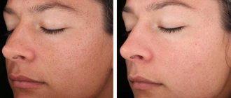 Эрбиевый лазерный (фото до и после)