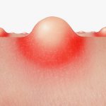 Эволюция угрей: от комедонов к папулам и гнойникам