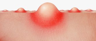 Evolution of acne: from comedones to papules and abscesses