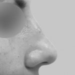 photo before non-surgical rhinoplasty