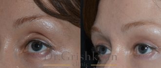 photo before and after lipofilling of the upper eyelid photo