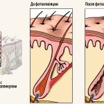 Фотоэпиляция