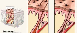 Фотоэпиляция