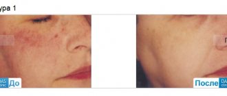 fractional photothermolysis