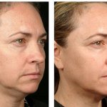 Гиалуформ заметно освежает кожу лица