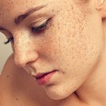 Гиперпигментация кожи