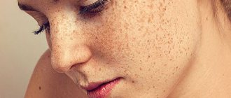 Skin hyperpigmentation