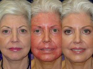 Глубокий пилинг лица: фото до и после процедуры
