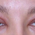 headache after Botox and swelling of the eyes