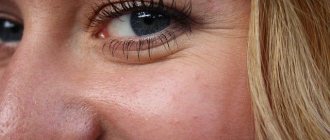 гусиные лапки вокруг глаз