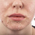 химический пилинг