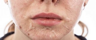 chemical peeling