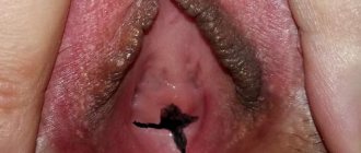 Surgical defloration is done in a standard way