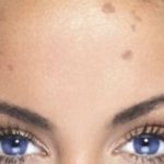 Хлоазма на лице причины и лечение