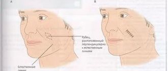 Scar excision