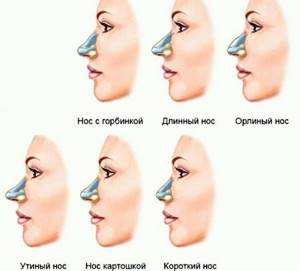 Как исправить нос картошкой у женщины. Ринопластика, фото до и после операции, цена