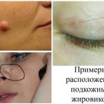 How to get rid of wen on the face at home. Causes 