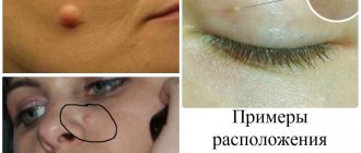 How to get rid of wen on the face at home. Causes