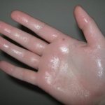 How does hyperhidrosis manifest?