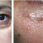 Как убрать филлеры под глазами