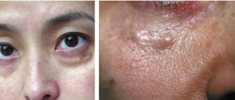 How to remove fillers under the eyes