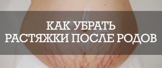 Как убрать растяжки после родов