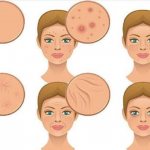 как убрать воспаление прыща на лице